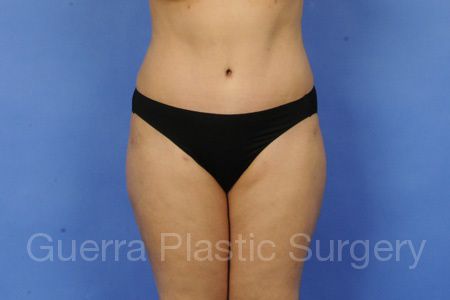 next Case #38965 After