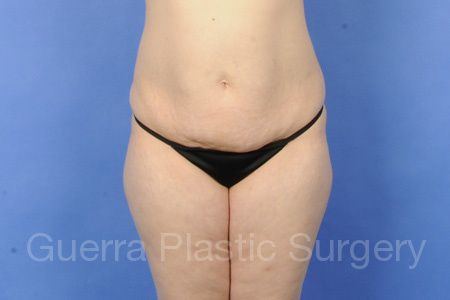 next Case #36977 Before