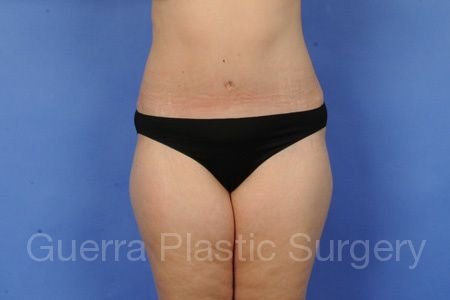 next Case #36977 After