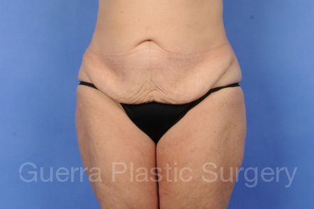 next Case #35478 Before