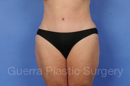 next Case #35478 After