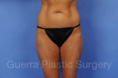 next Case #87965 Before