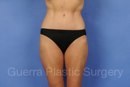 next Case #87965 After