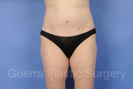 prev Case #11223 After