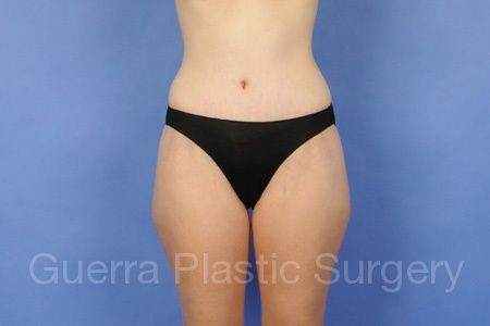 prev Case #45789 After