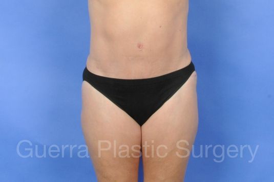 prev Case #01234 After