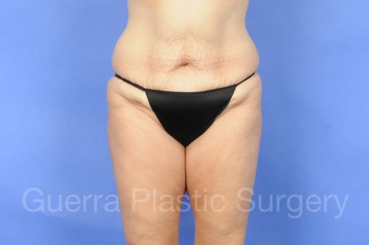 next Case #01235 Before