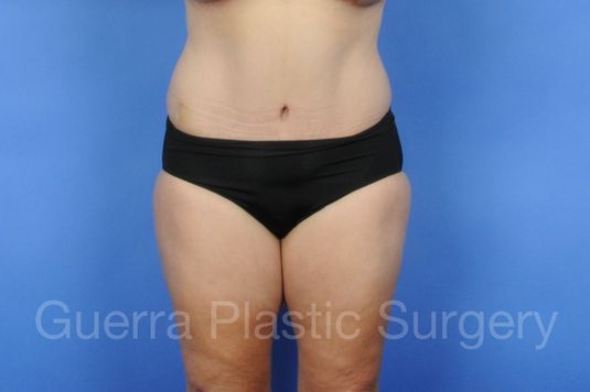 next Case #01235 After