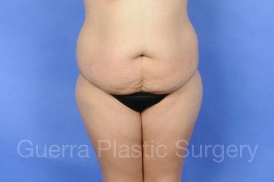 next Case #01238 Before