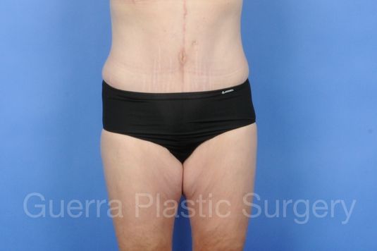 next Case #01255 After