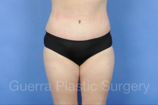 next Case #01272 After