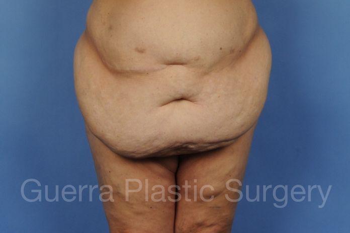 Tummy Tuck Case #01274 - before