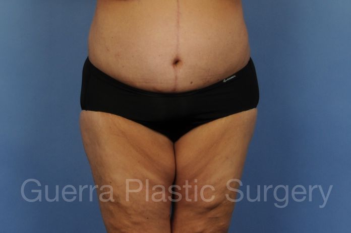 Tummy Tuck Case #01274 - after