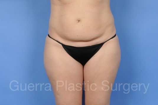 next Case #01281 Before