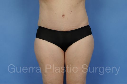 next Case #01281 After