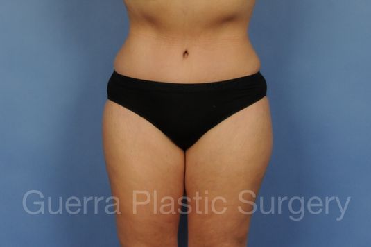 next Case #01296 After