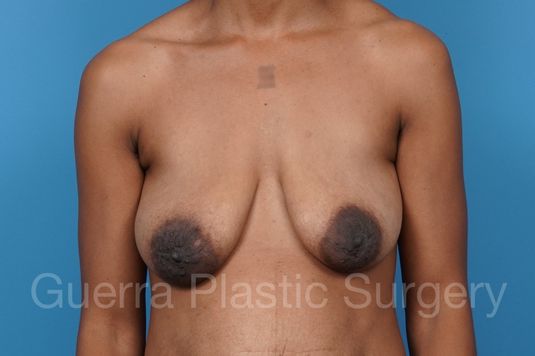 Before Photo Breast Lift / Implant