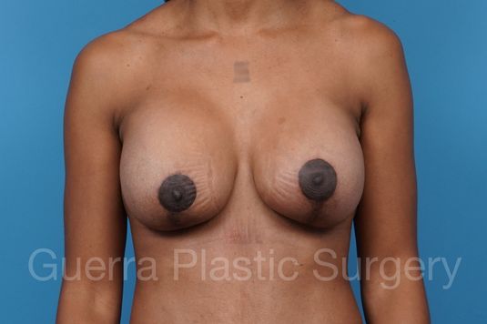 After Photo Breast Lift / Implant