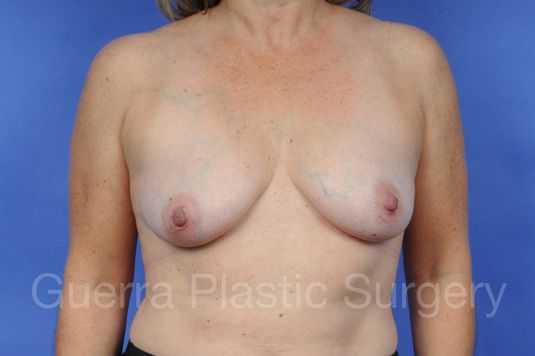 Case #1101002 Before