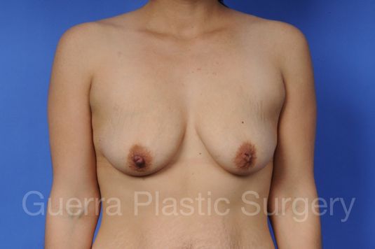 Case #1103008 Before