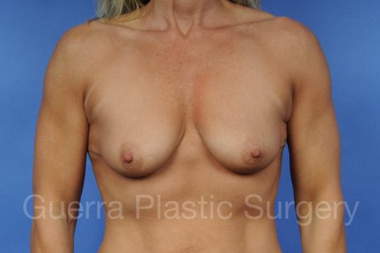 Case #1106002 Before