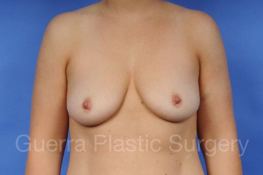 Case #1109001 Before