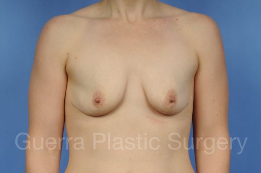 Case #1101015 Before