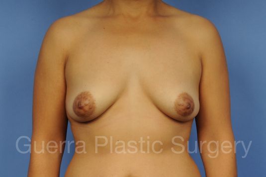 Case #1101018 Before