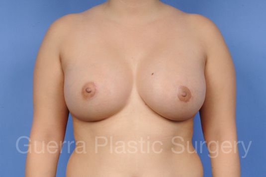 prev Case #1101020 After