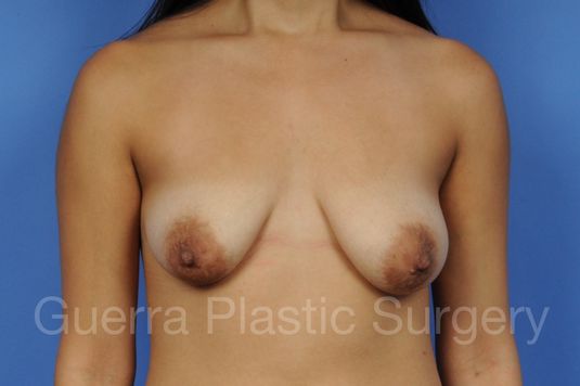 next Case #1103012 Before