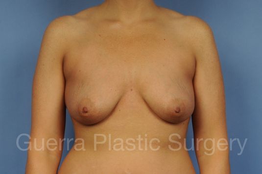 Case #1103015 Before