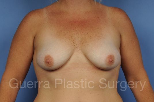 Case #1104003 Before