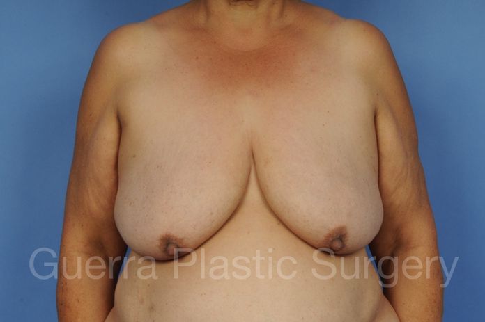 Breast Lift / Implant Case #1112005 - before