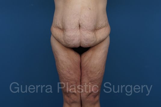 Before Photo Thigh Lift
