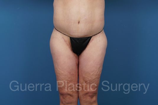 After Photo Thigh Lift