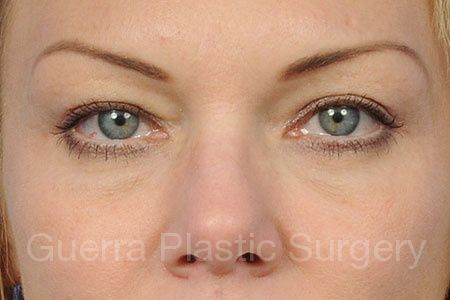 After Photo Eyelid Surgery