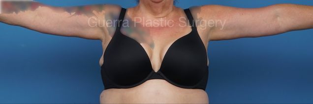 After Photo Arm Lift