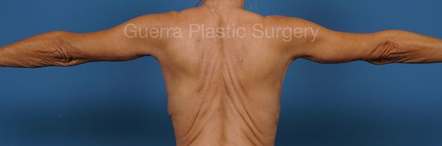 After Photo Arm Lift