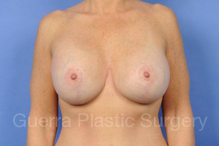 prev Case #65781 After