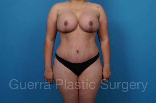 prev Case #35814 After