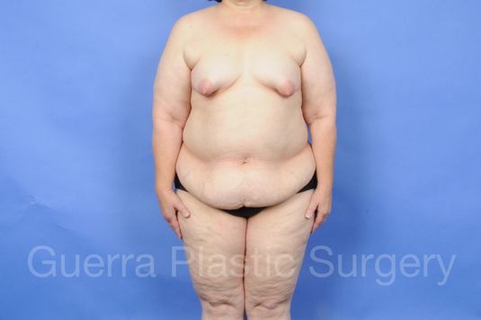 next Case #28077 Before