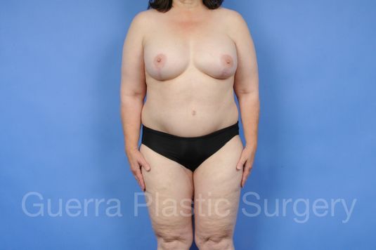 next Case #28077 After