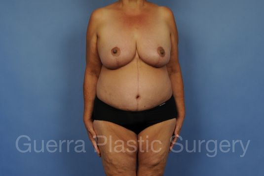 prev Case #28080 After