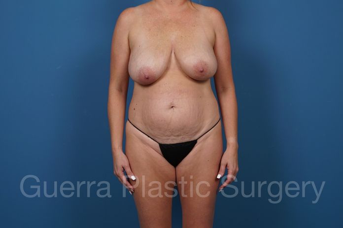 Mommy Makeover Case #27651 - before