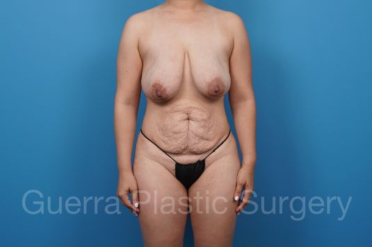 Before Photo Tummy Tuck with Breast Reduction