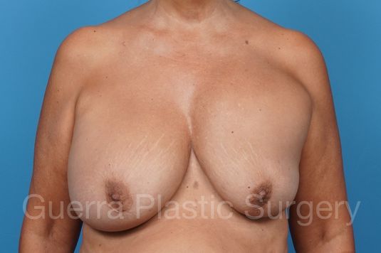 next Case #38550 Before
