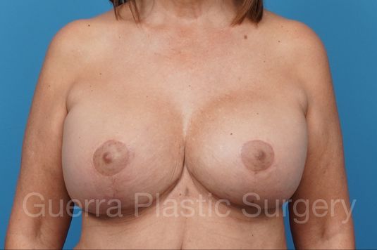 next Case #38550 After