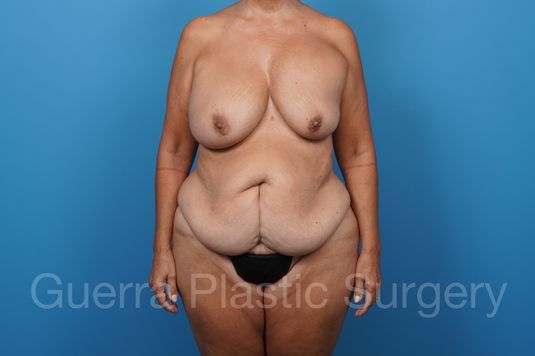 Before Photo Tummy Tuck + Breast Lift / Exchange