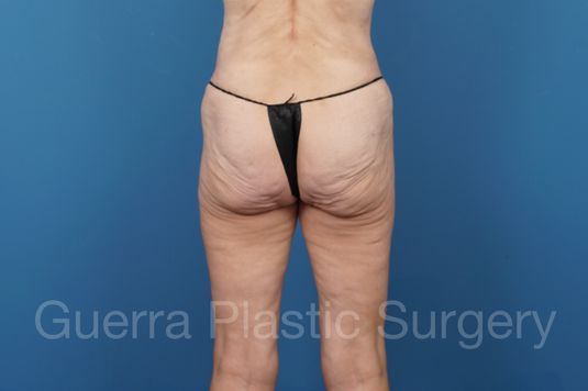 Before Photo Spiral Thigh Lift