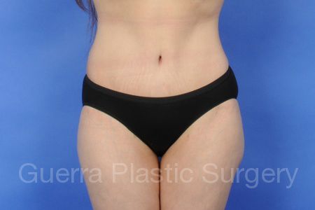 prev Case #5762 After